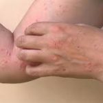 أول لقاح معتمد ضد جدري القردة.. والصحة العالمية تصنفه "حالة طوارئ صحية" 52 vb